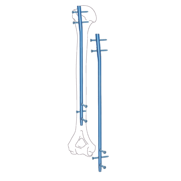 Humerus Nail